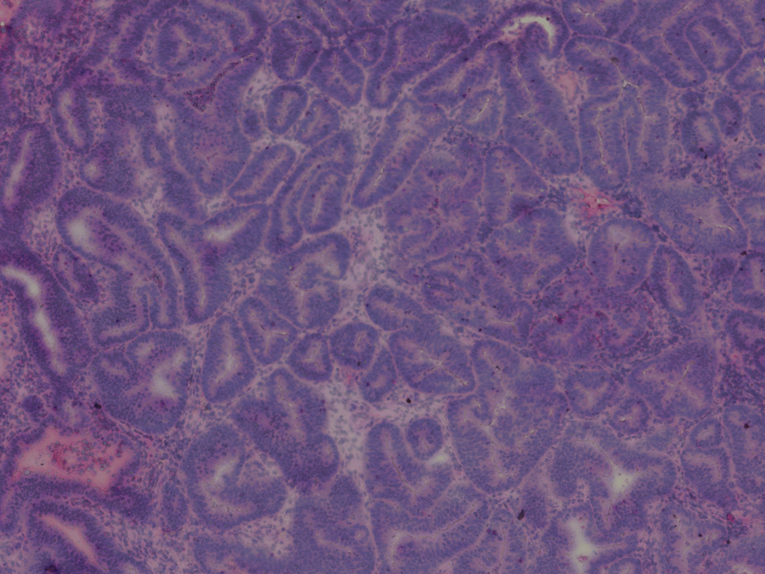 Histopathological slide of ovarian cancer tissue stained with hematoxylin and eosin, showing purple and pink colors.